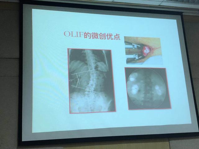 仅需40分钟!邵逸夫医院针对腰椎退行性病人有了更好的治疗方案